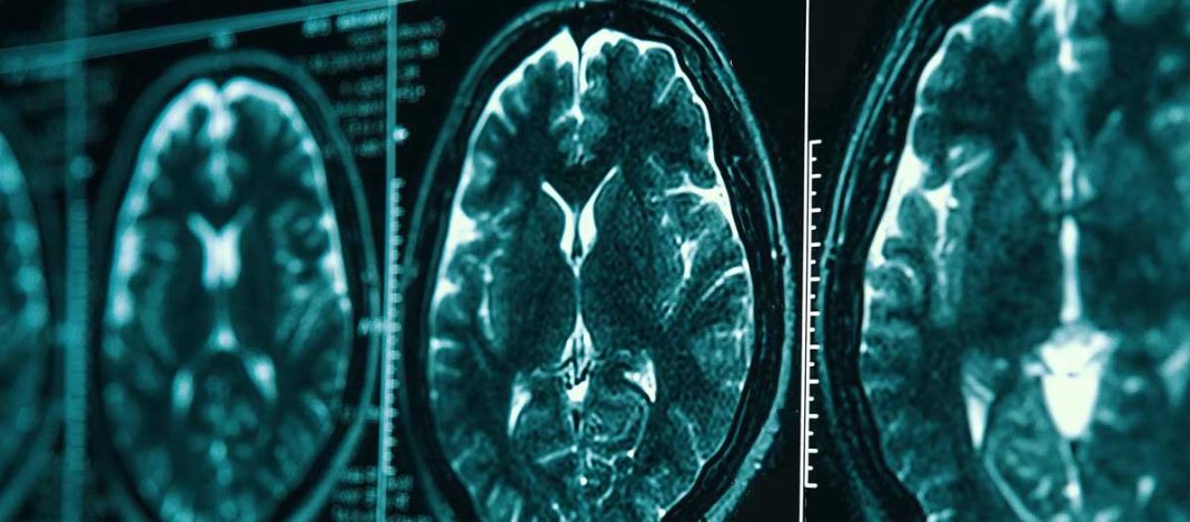 Penelitian Neuroimaging Memastikan Perlindungan Kognitif yang Diberikan oleh ART yang Efektif