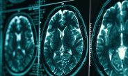 Penelitian Neuroimaging Memastikan Perlindungan Kognitif yang Diberikan oleh ART yang Efektif