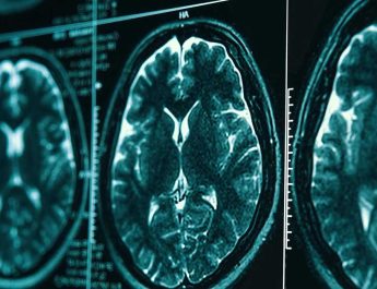 Penelitian Neuroimaging Memastikan Perlindungan Kognitif yang Diberikan oleh ART yang Efektif