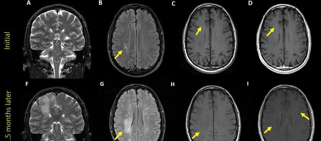 Longitudinal Changes in Cognition and Brain Imaging in Persons with HIV