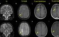 Longitudinal Changes in Cognition and Brain Imaging in Persons with HIV