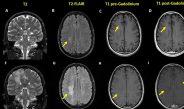 Longitudinal Changes in Cognition and Brain Imaging in Persons with HIV