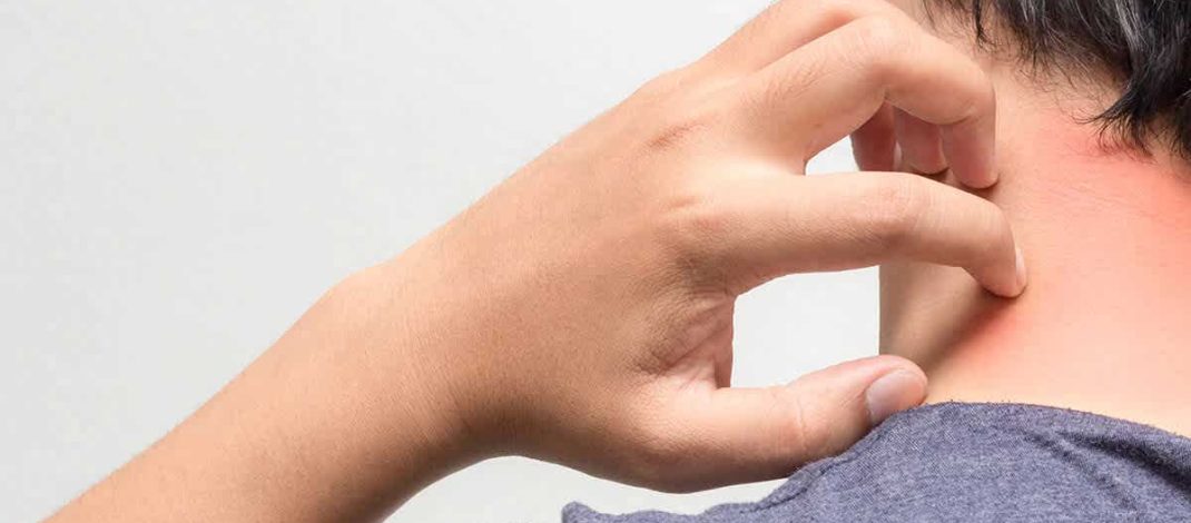Riwayat Penyakit Kulit Masih Menjadi Masalah Umum Pada ODHIV