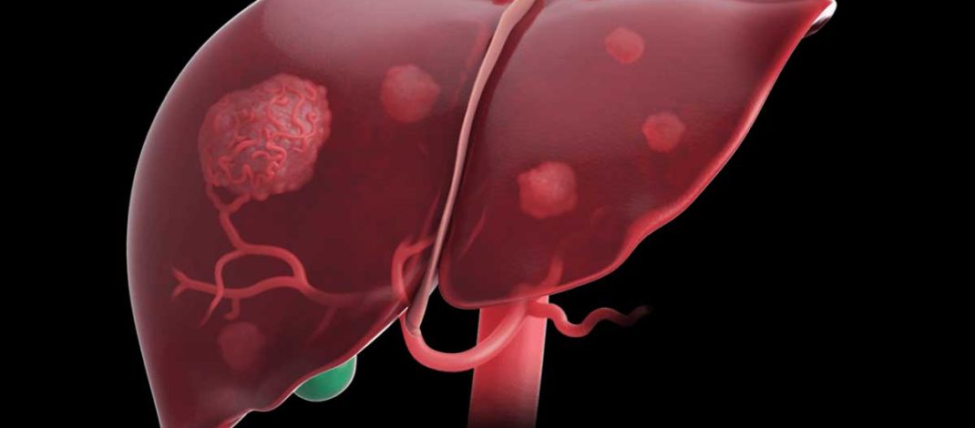 Adherence to Hepatocelullar Carcinoma Surveillance Guidelines