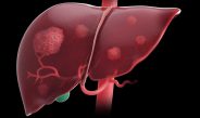 Adherence to Hepatocelullar Carcinoma Surveillance Guidelines
