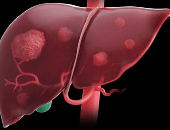 Adherence to Hepatocelullar Carcinoma Surveillance Guidelines